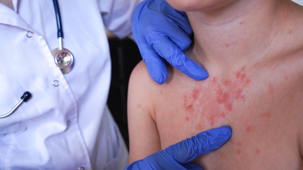 Minnesota's 80 measles cases this year are the most since 1990, health officials say — Oakdale Health news